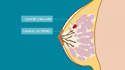 Le Cancer du sein et l'utérus le 18/02/2021 a 11H